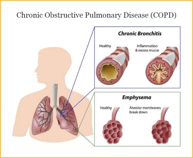 COPD