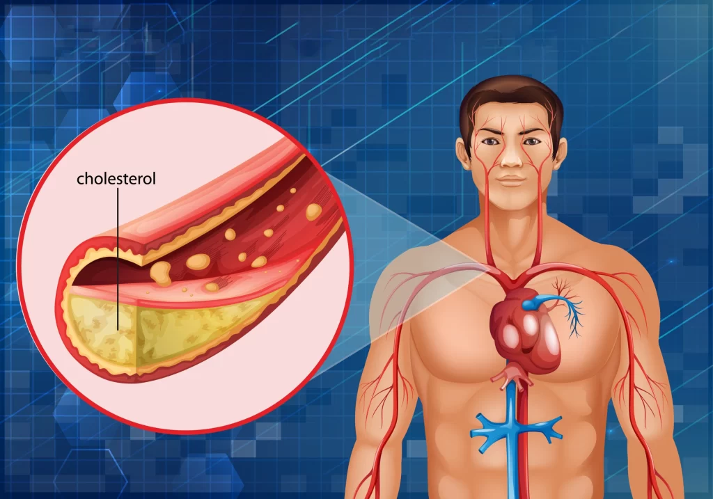 High Cholesterol