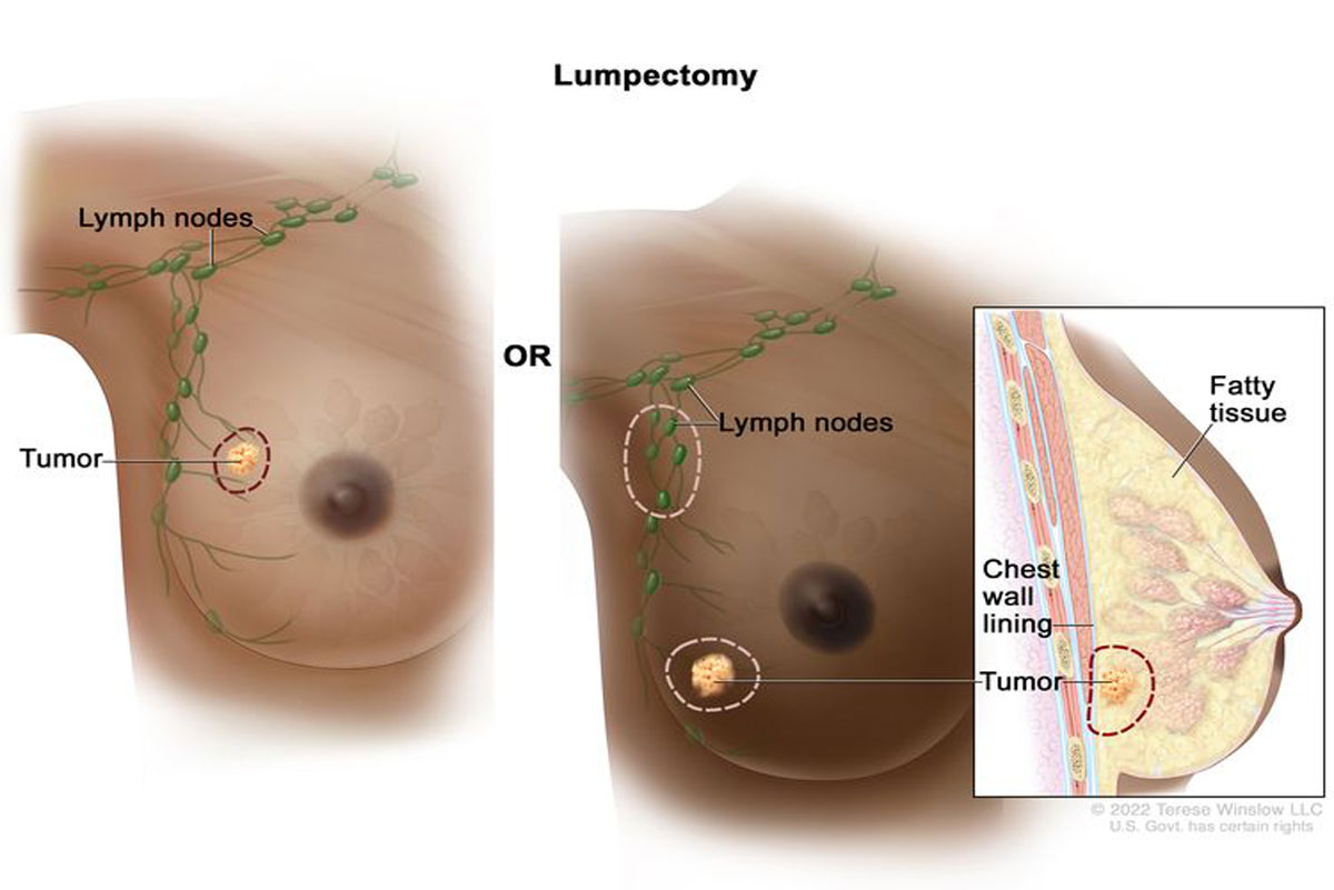 Breast Cancer